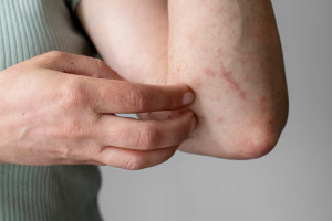 Perbedaan Gejala Campak dan Alergi, Sama-sama Ada Ruam